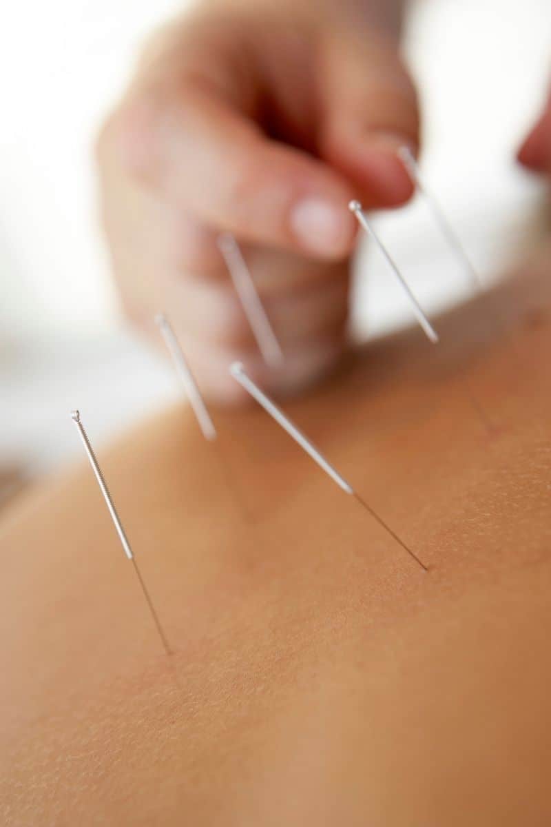Acupuncture For Pain Relief Summary