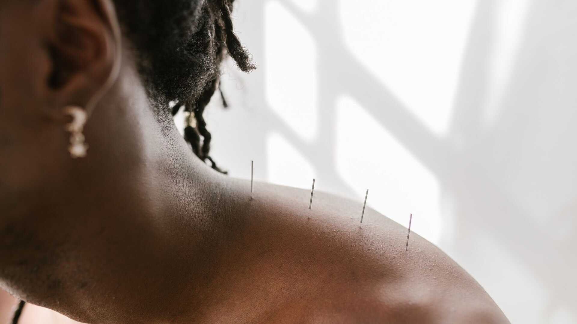 Acupuncture For Pain Relief