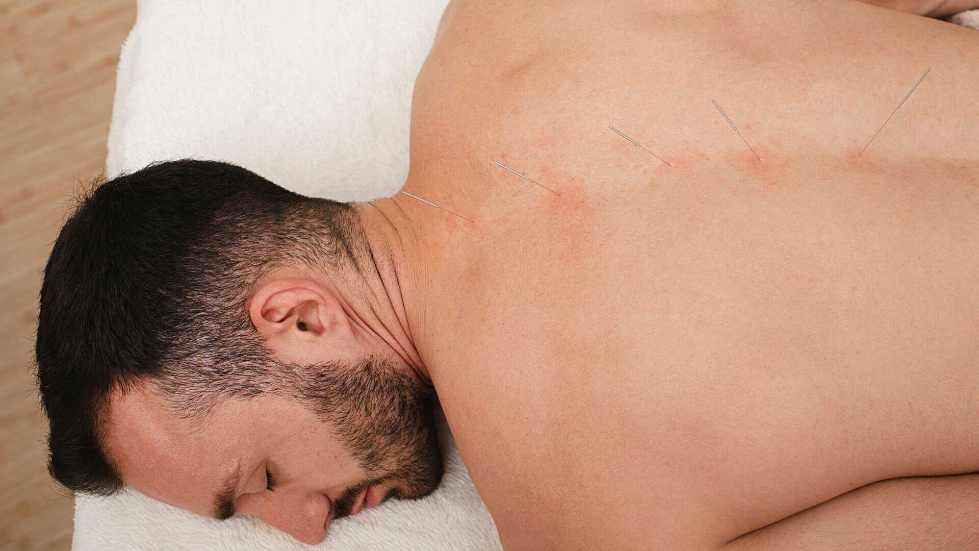 Acupuncture For Wellness Support Benefits