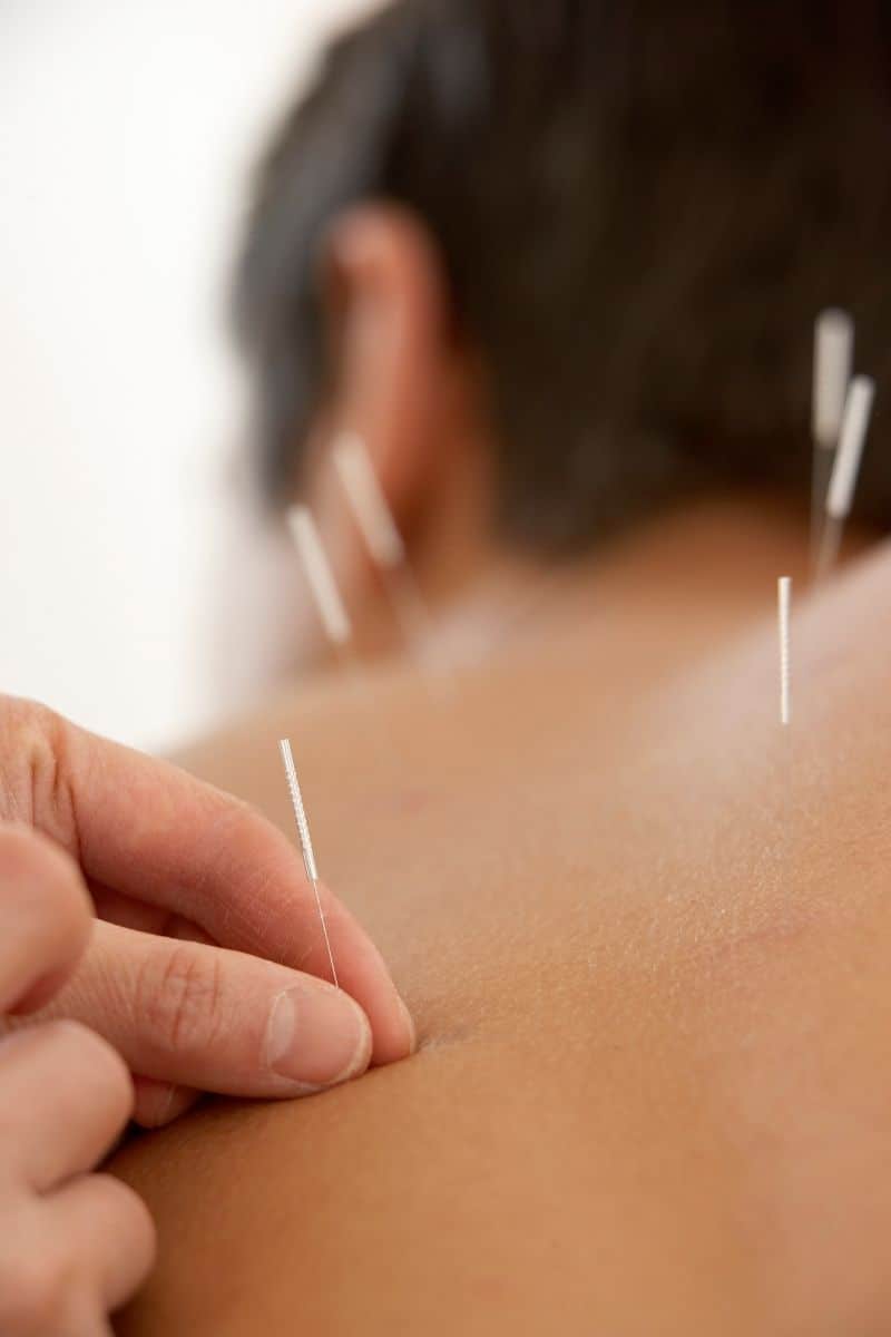 Acupuncture Summary