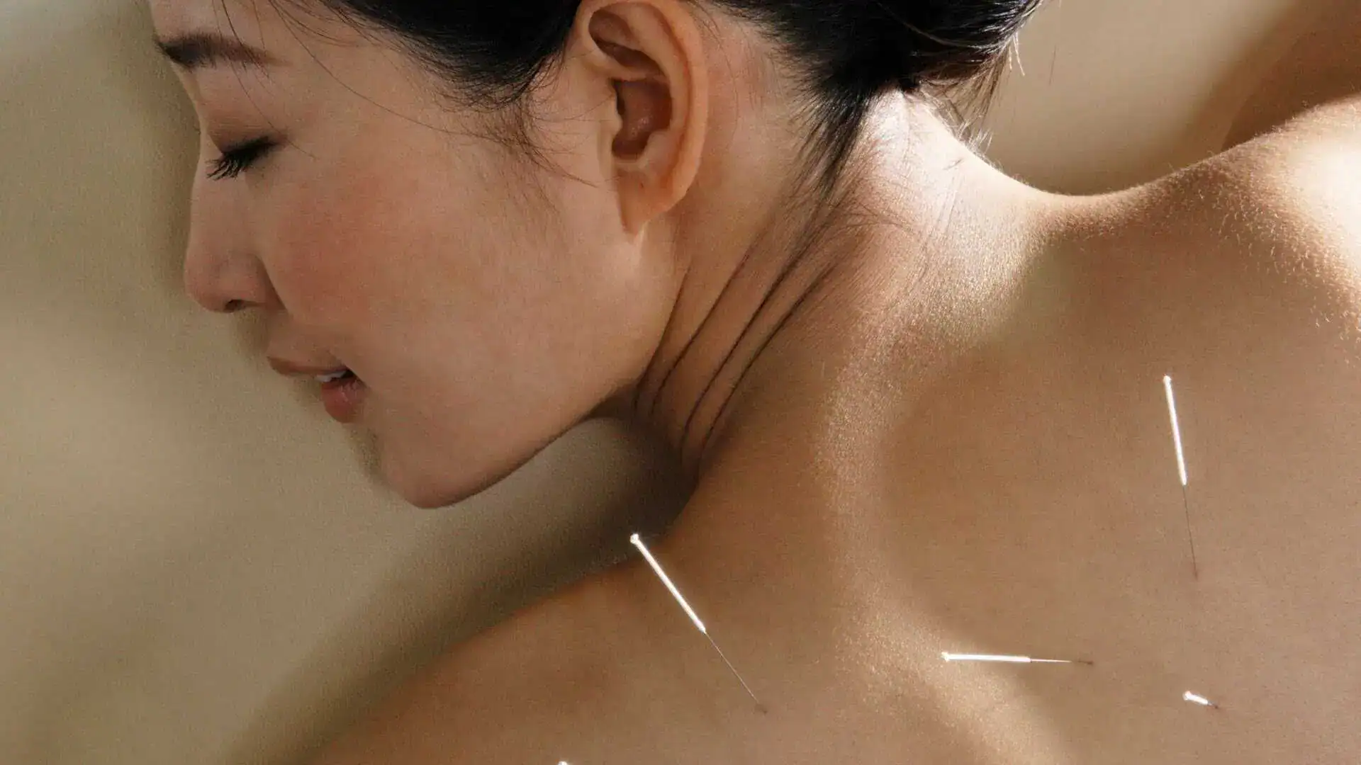Acupuncture for Chronic Pain Migraines hero