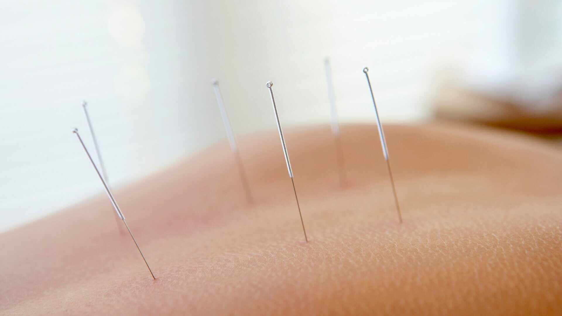 Acupuncture for Digestive Disorders Benefits