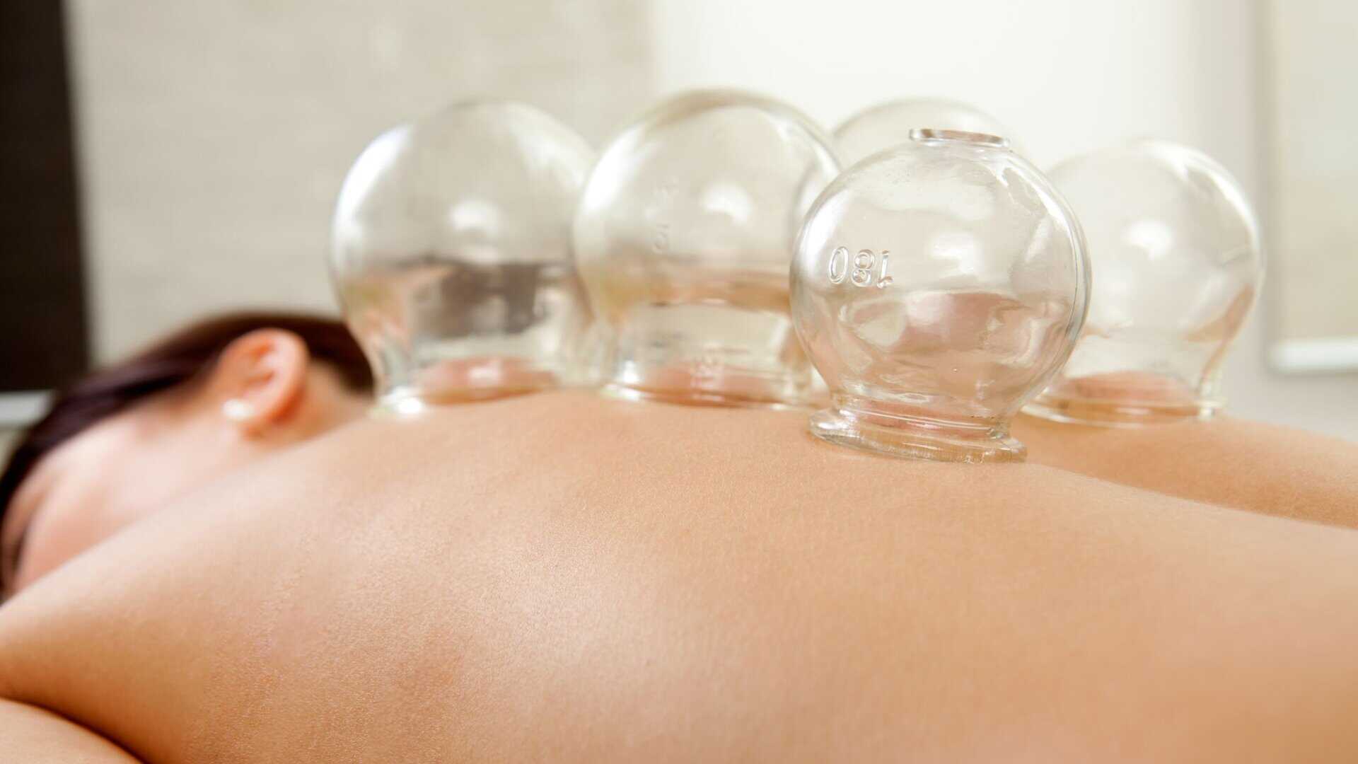 Cupping Therapy